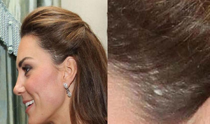 Какую операцию сделали кейт. Шрам Кейт Миддлтон. Кейт Миддлтон шрам на голове. Кейт Миддлтон нос. Кейт Миддлтон пластические операции.