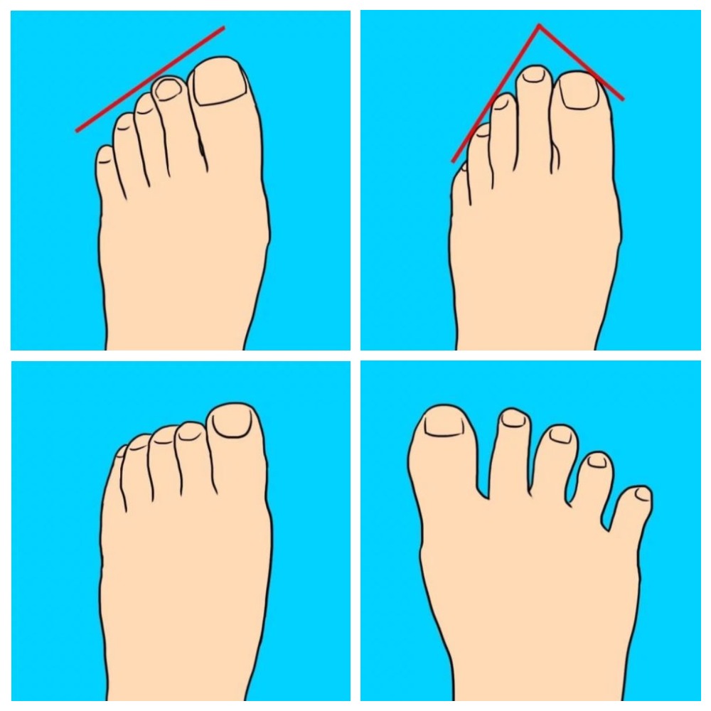 Какие бывают пальцы ног. Форма пальцев стопы. Форма пальцев на ногах. Типы расположения пальцев на ноге. Правильная форма пальцев на ногах.