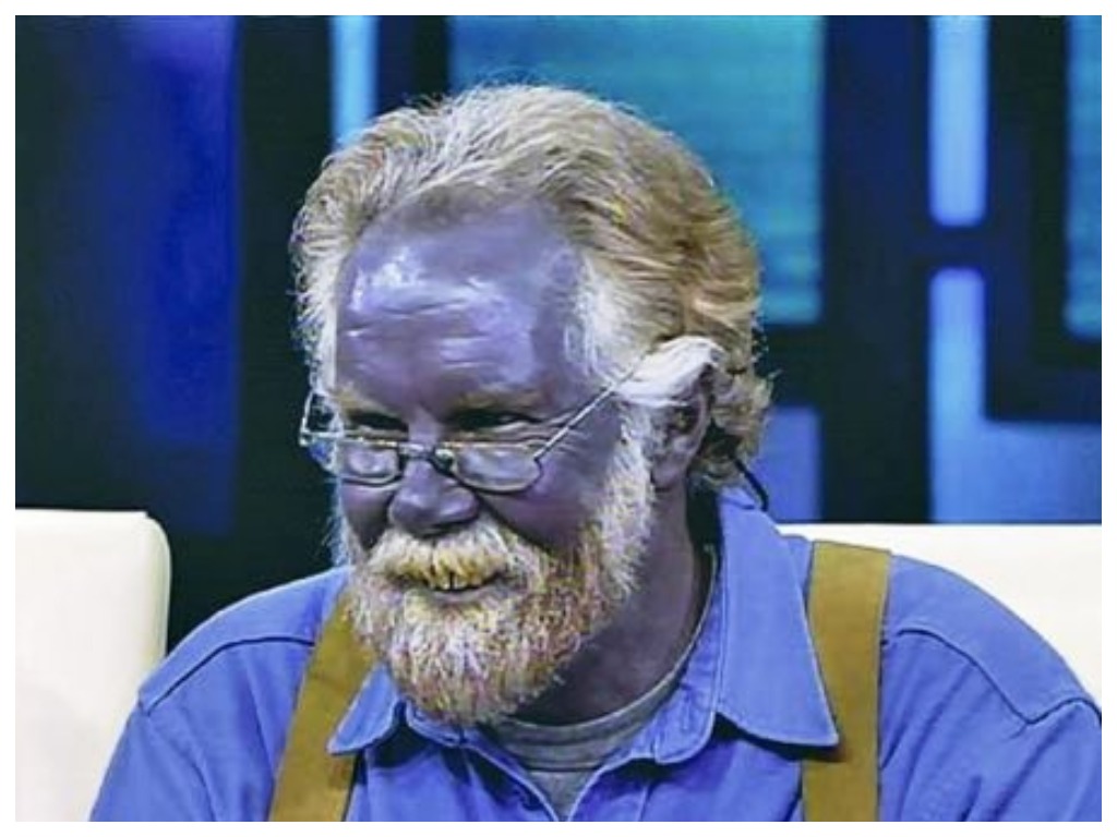 Синяя кожа у человека