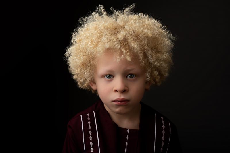 Очаровательный мальчик. Темнокожий альбинос. Негр альбинос фото с голубыми глазами.