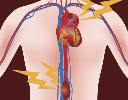 аневризма аорты сердца