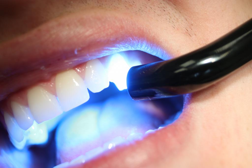 Стоматолог засвечивает пломбу фотополимерной лампой