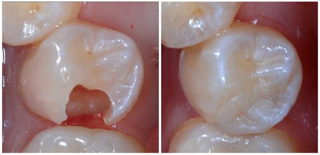Зуб в процессе и после реставрации