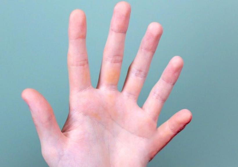 Люди с 6 пальцами на руках фото