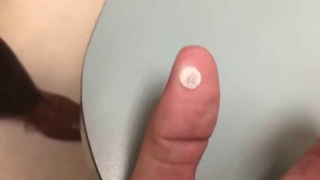 finger removal