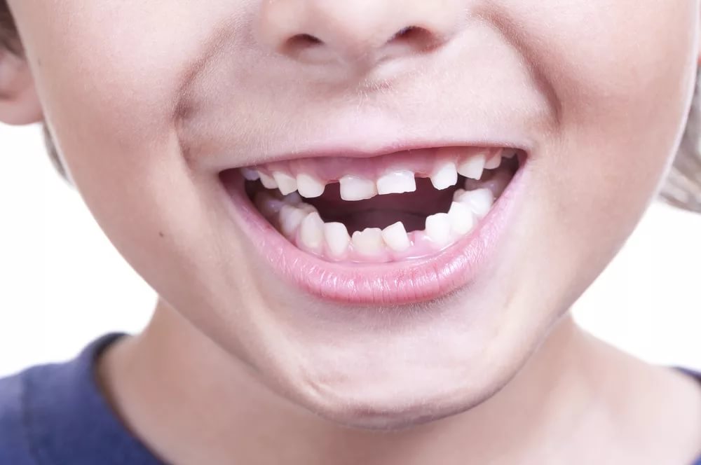 Редкие зубы у ребенка