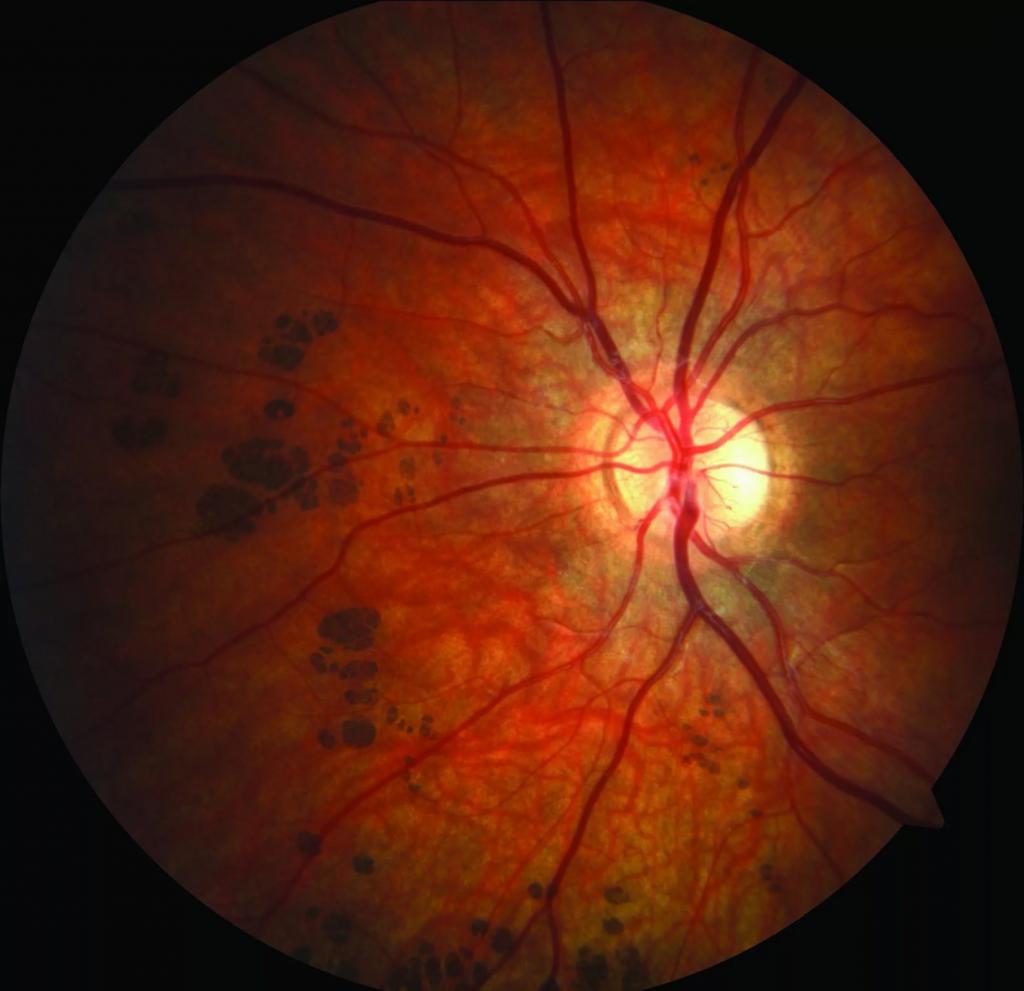 День сетчатки. Пигментный ретинит сетчатки. Пигментная дистрофия (ретинит). Тапеторетинальная дистрофия сетчатки. Хориоретинальная дегенерация сетчатки.