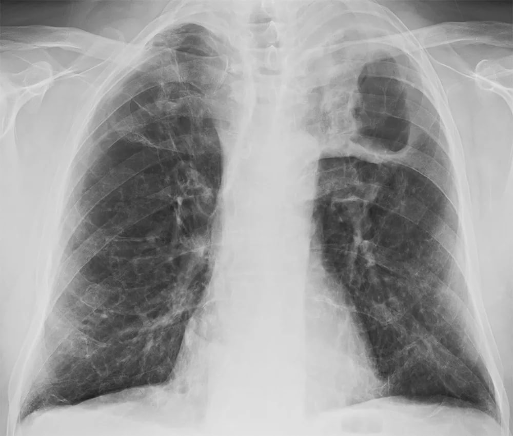 Вторичный туберкулез: формы, причины, симптомы, диагностика и лечение