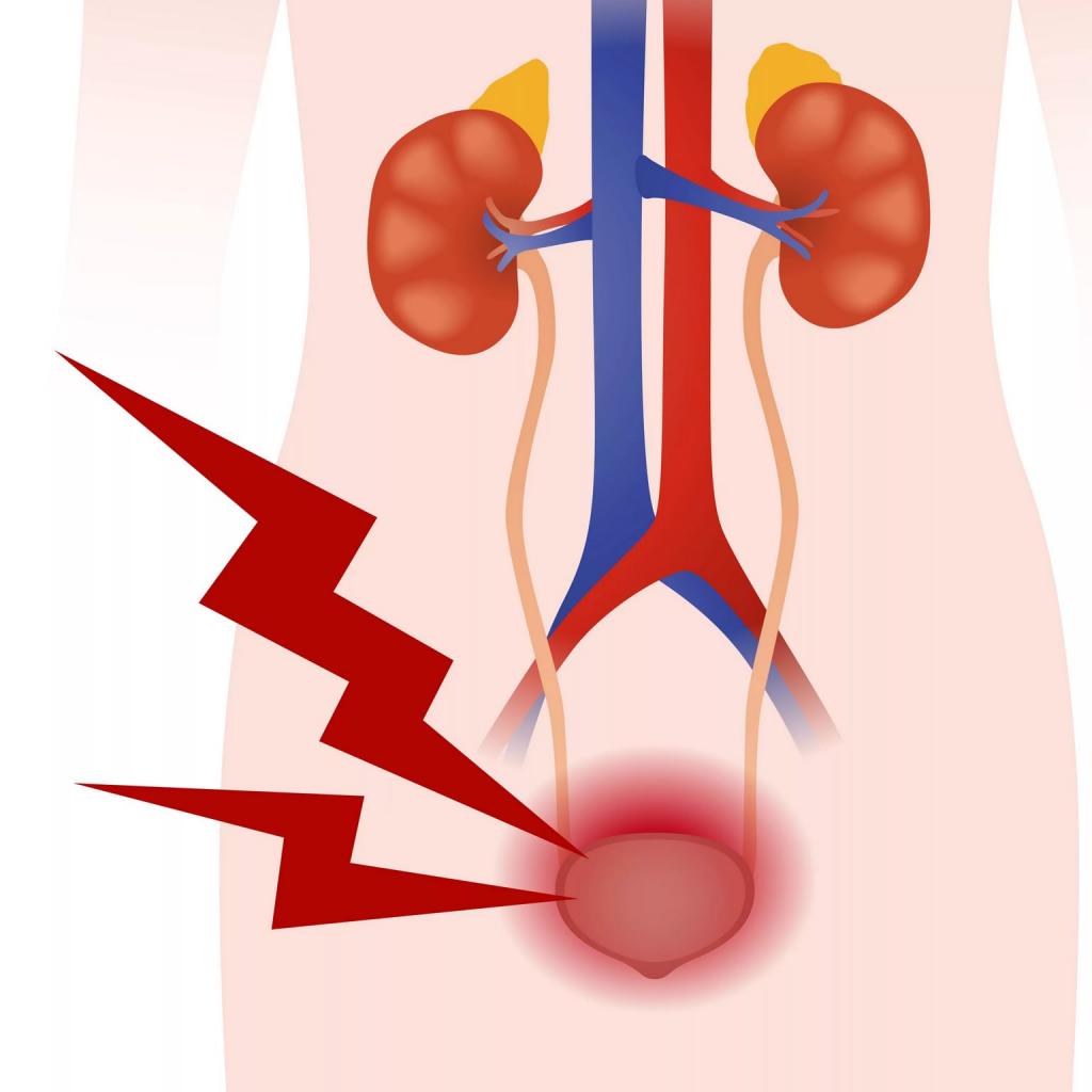 Inflammation of the bladder