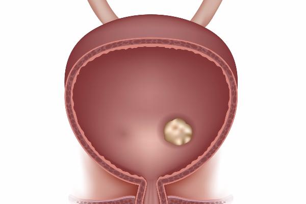 Urolithiasis disease