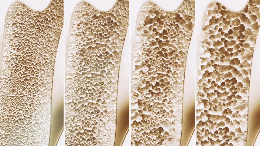 Изменения костной ткани при остеопорозе