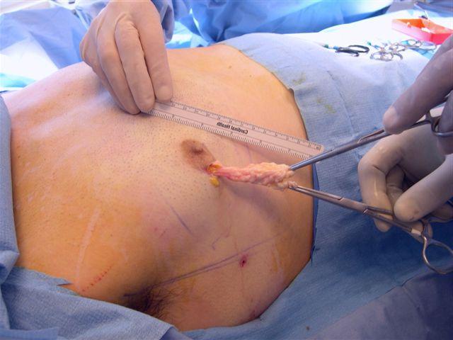 гинекомастия операция