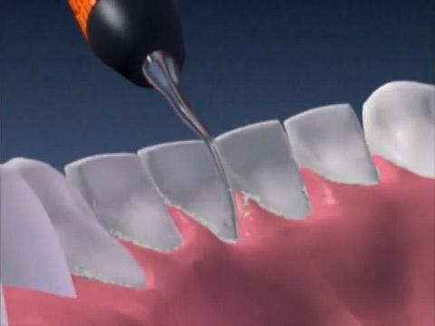 Чистка зубов ультразвуком - стоимость