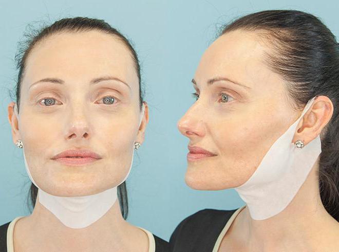 Убрать подбородок без операции. Анджелина Джоли ментопластика. Пластическая операция на шее. Подтяжка подбородка. Подтяжка шеи и подбородка.