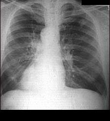 Рак лёгких рентген