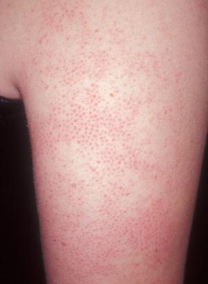 Лечение кожной сыпи в Кривом Роге – дерматолог, аллерголог