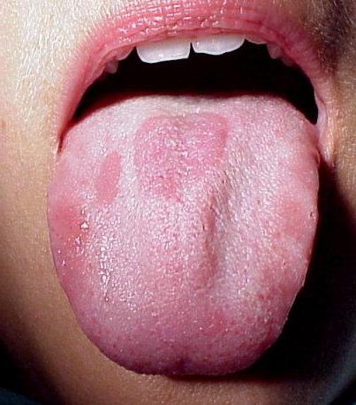 dry tongue white coating