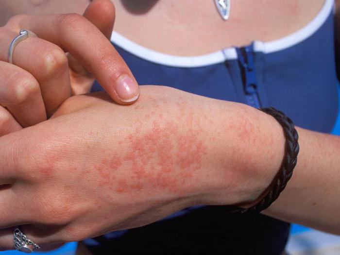 Может ли быть аллергия на жару у грудничка thumbnail