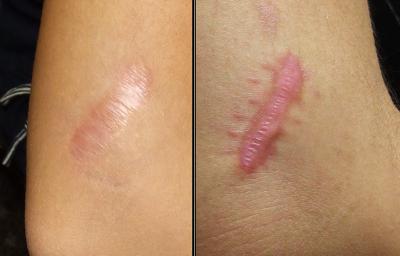 postoperative scar removal