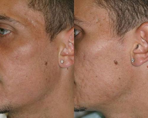 laser scar removal