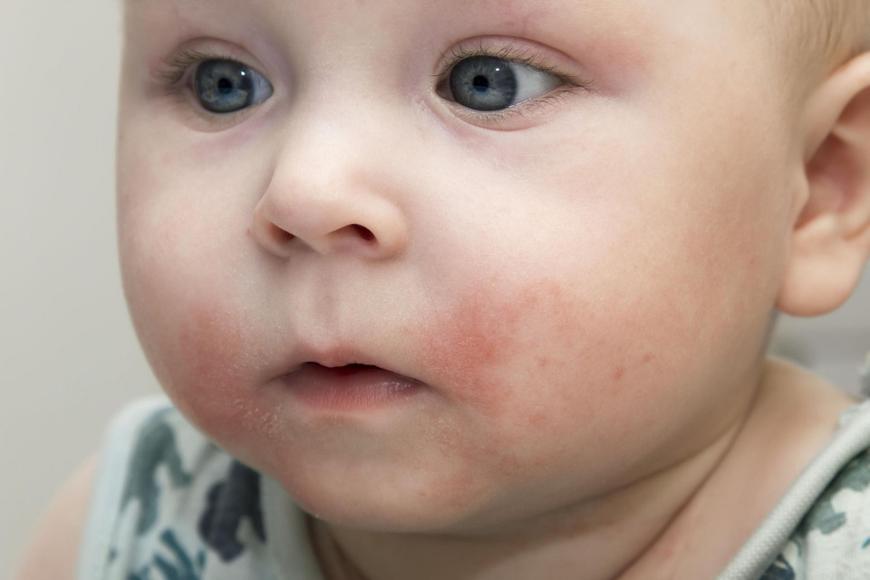 Аллергия на мыло у малышей