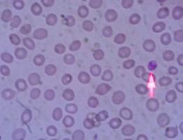 platelets in the blood are normal