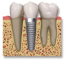 Имплантанты зубов