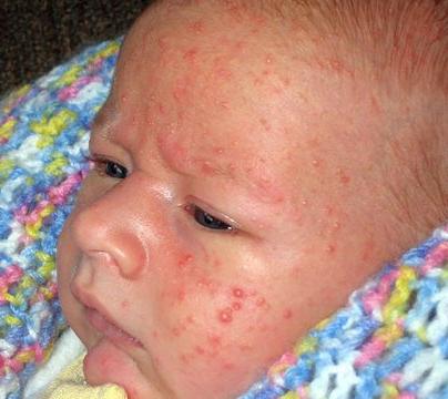 Аллергия в горле у ребенка фото