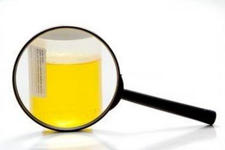 Oxalates in the urine of a child