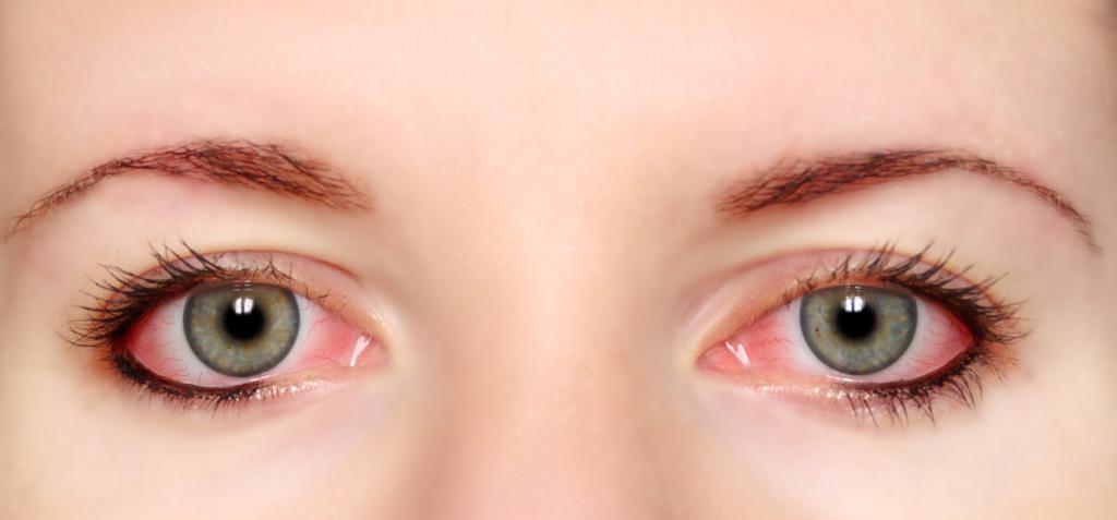 red capillaries in the eyes of a child