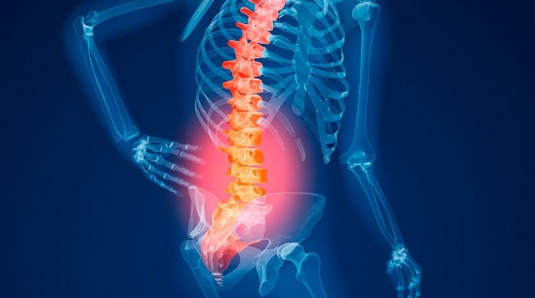 остеохондропатия поясничного отдела позвоночника