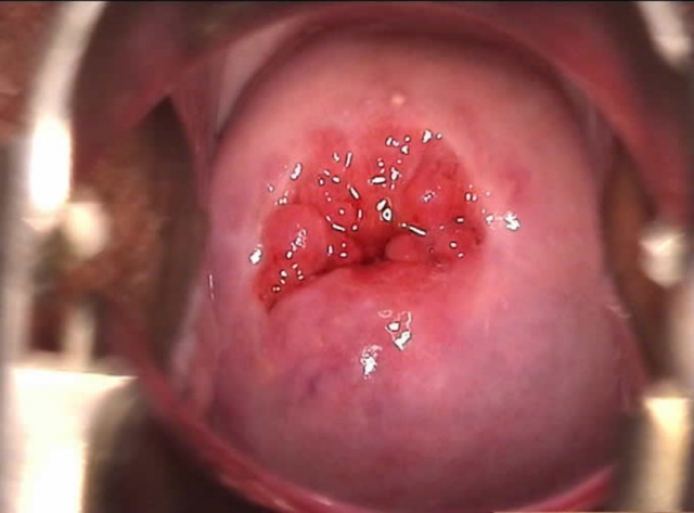 erythroplakia of the cervix