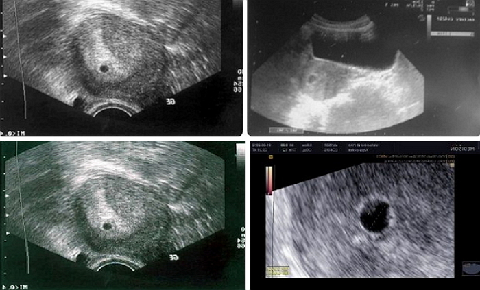 Фото узи эмбриона на 4 неделе беременности фото