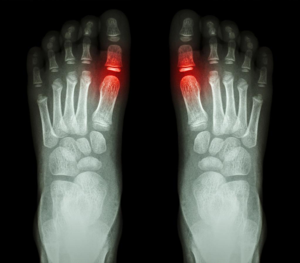 Ревматоидный артрит стопы рентген