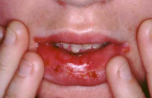 предраковые заболевания полости рта 