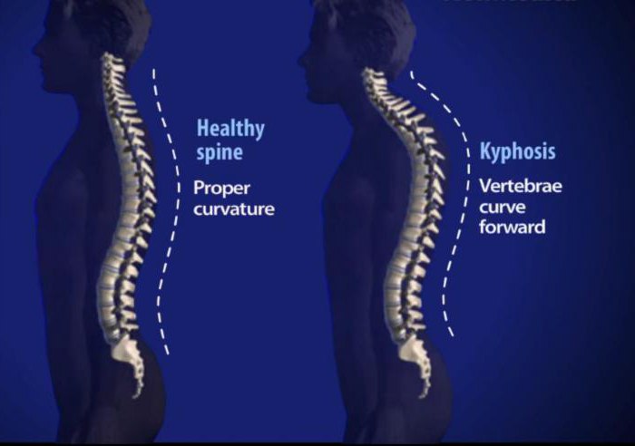 Кифоз шейного отдела что это фото