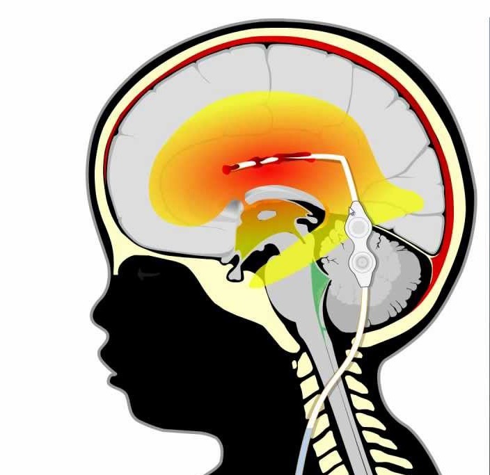 Шунтирование головного мозга при гидроцефалии последствия
