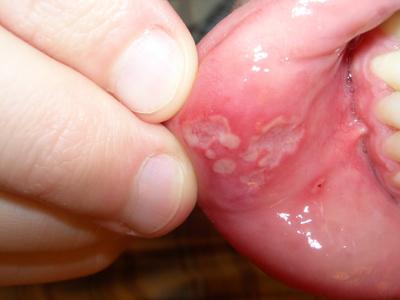 treatment of stomatitis in children at home