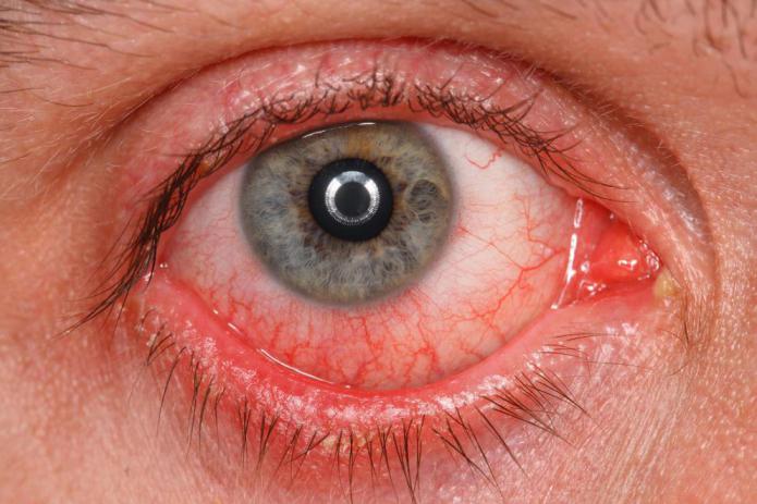 макулодистрофия сетчатки глаза влажная форма
