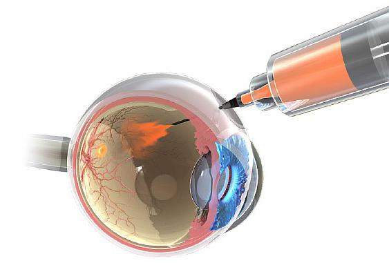 макулодистрофия сетчатки глаза лечение