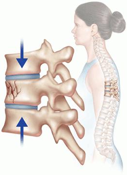 компрессионный перелом грудного отдела позвоночника