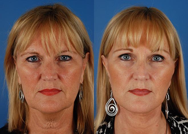 facelift result