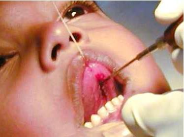 trimming the frenum of a child’s tongue