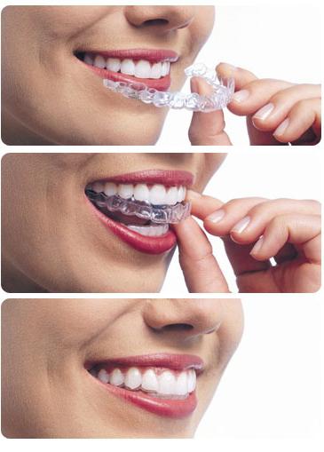 зубы после брекетов