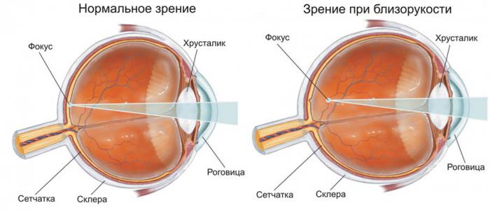 myopia is a plus or minus