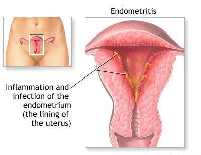 Что такое эндометрит у женщин