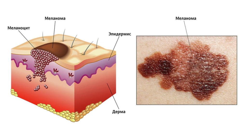 Опасные родинки: чем они могут быть опасны
