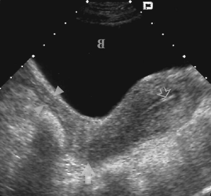 Эндометрий 1 мм. Эндометрий матки норма УЗИ. Атрофический эндометрит.