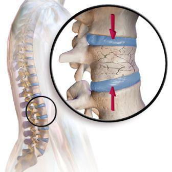 компрессионный перелом позвоночника у ребенка