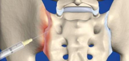 Обезболивающие уколы при остеохондрозе поясничного отдела позвоночника thumbnail